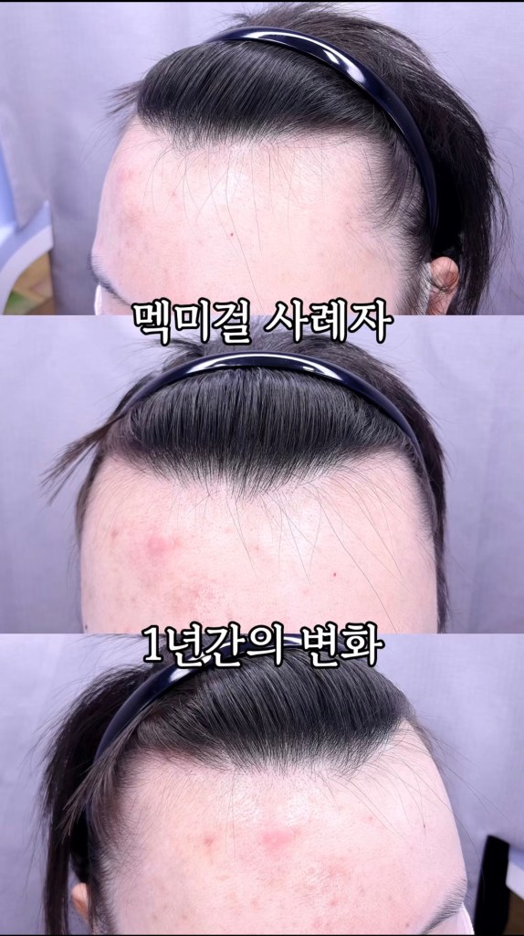 모발이식 전후 사례