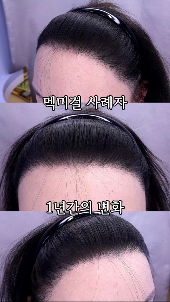 모발이식 전후 사례