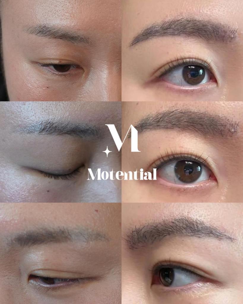 청담 모텐셜의원 눈썹이식 전후 사례