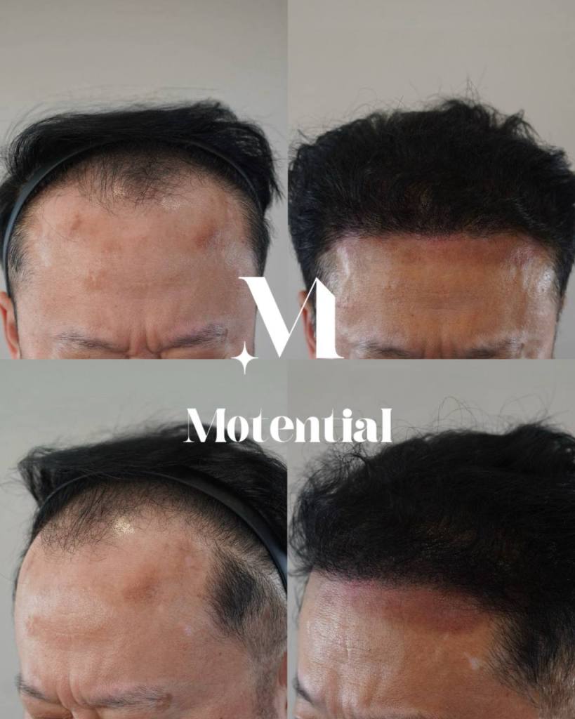 모발이식 전후 사례