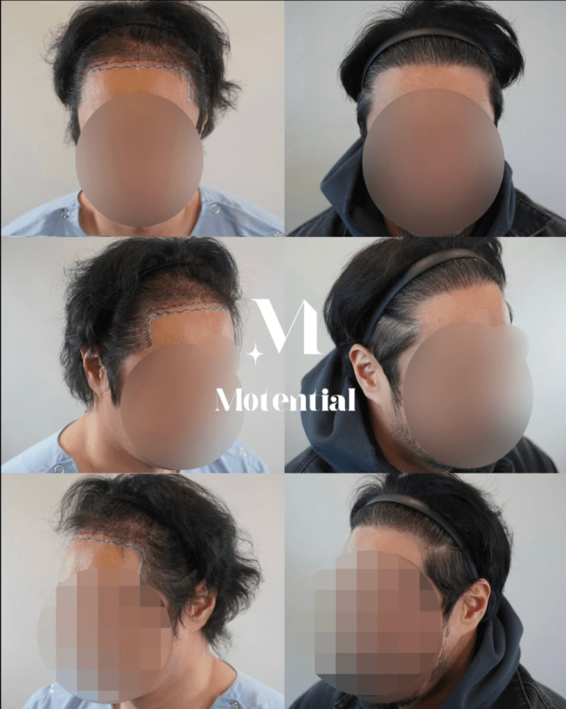 모발이식 전후 사례