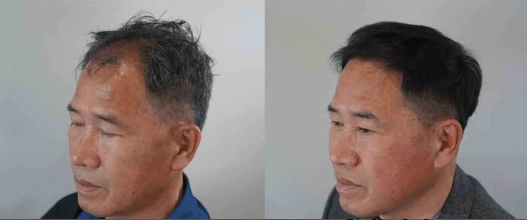 모발이식 전후 사례