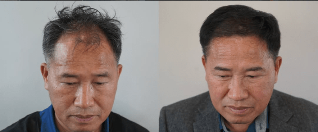 모발이식 전후 사례