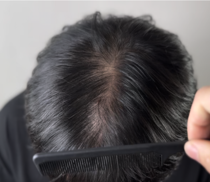 청담 모텐셜의원 두피문신(SMP) 시술 전