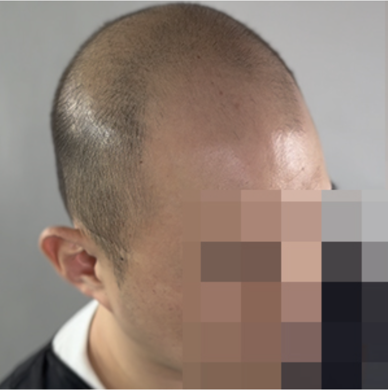 청담 모텐셜의원 두피문신(SMP) 시술 전