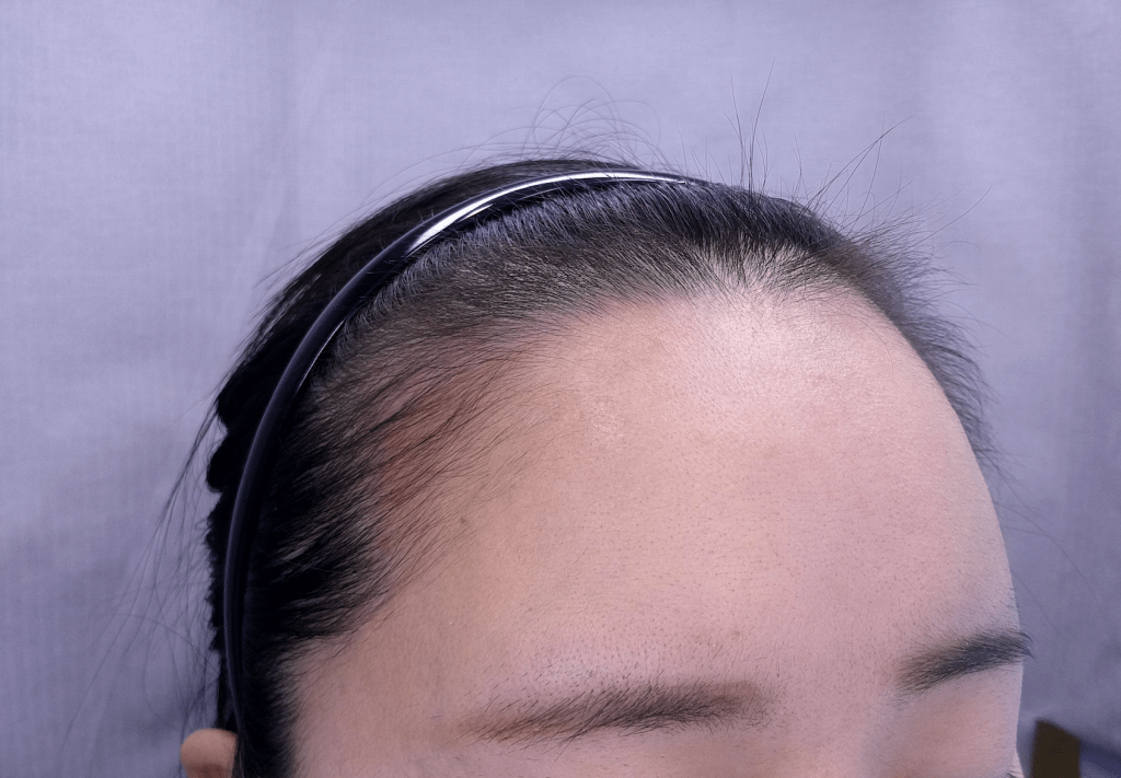 모발이식 전후 사례