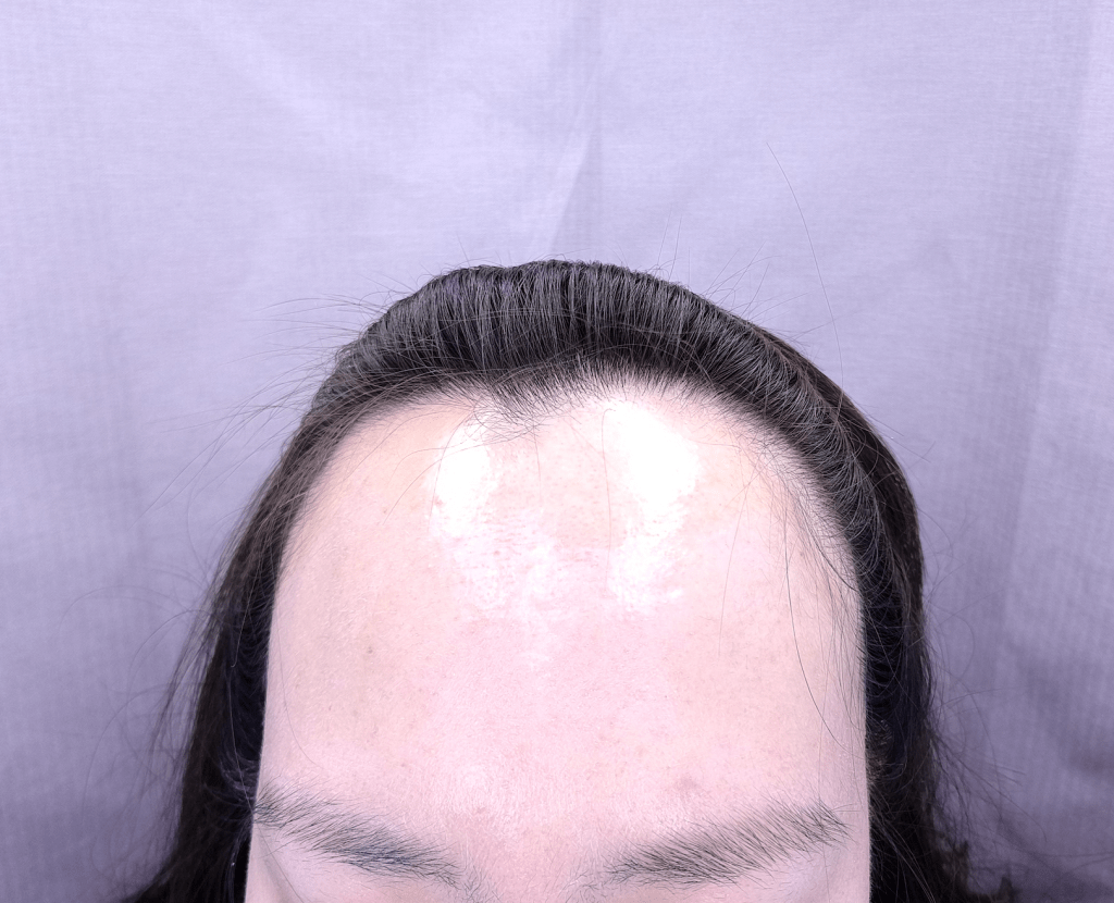 모발이식 전후 사례